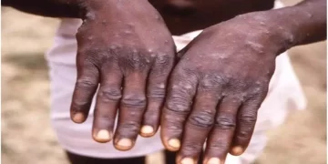 Monkeypox