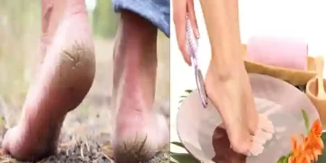 Cracked Feet