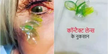 कॉन्टैक्ट लेन्स
