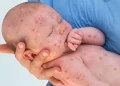 Measles Could Take a Dangerous Turn