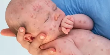 Measles Could Take a Dangerous Turn