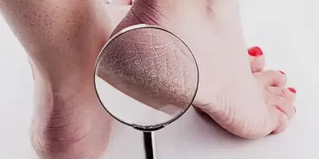 cracked heels