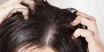 Dandruff
